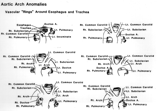 Image of vascular rings around esophagus and trachea