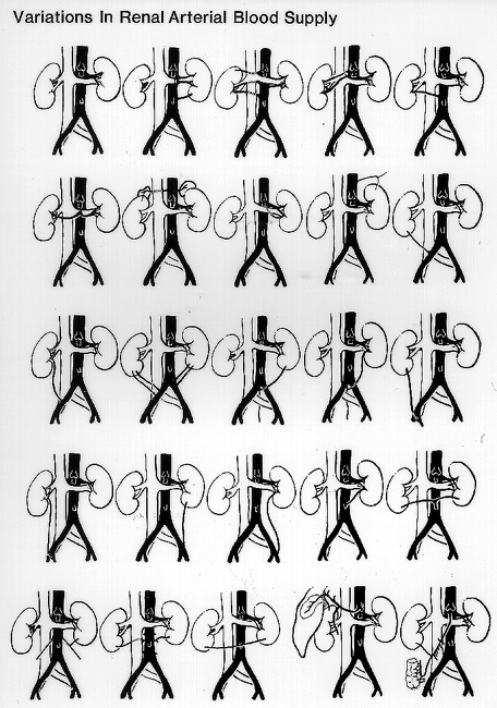 Image of variations in renal arterial supply