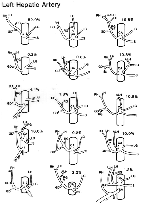 Image of variations in origin of left hepatic artery