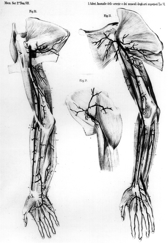 Image of absence of ulnar artery