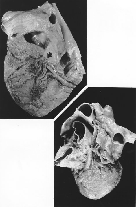 Image of absence of coronary sinus and great cardiac vein draining into superior vena cava