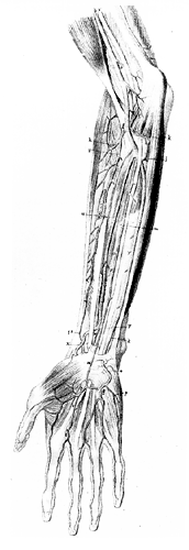 Image of Double Radial Artery and Persistent Median Artery, Superficial
Median Artery Replaces Radial Artery to Complete Superficial Palmar
Arch with Ulnar Artery