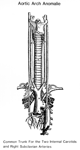 Image of the common trunk for the two common carotids and right subclavian artery