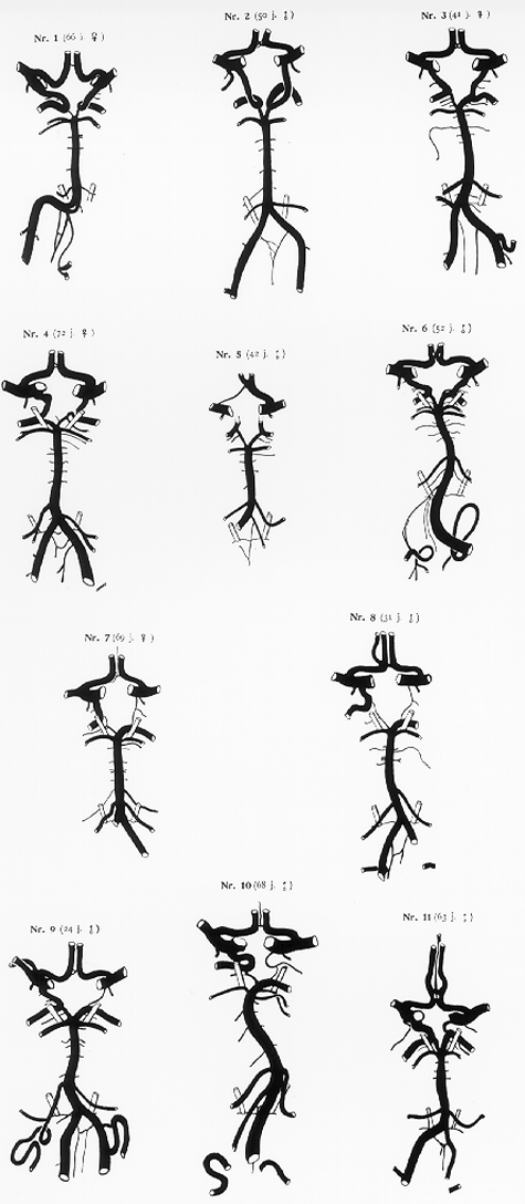 Image of variations in circle of Willis