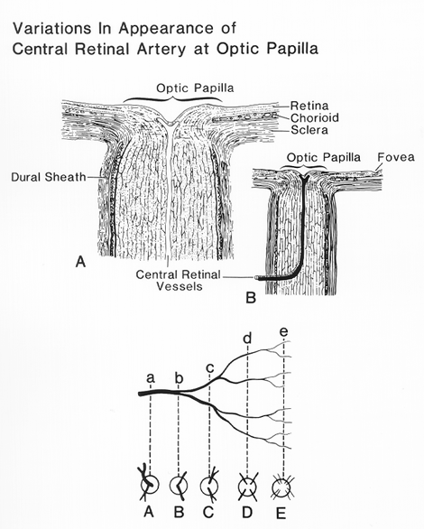 Image of variations in appearance of central retinal artery at the optic papilla