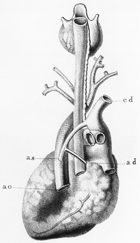 Image of duplication of azygos vein