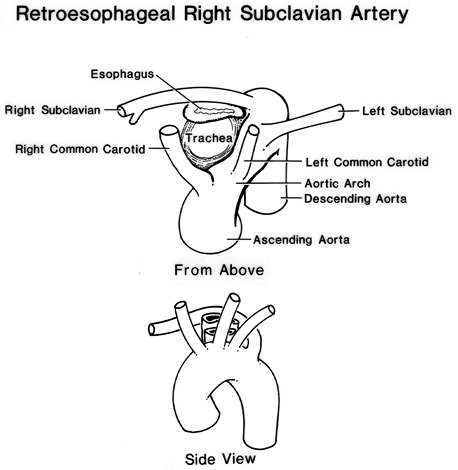 Image of retroesophageal right subclavian artery