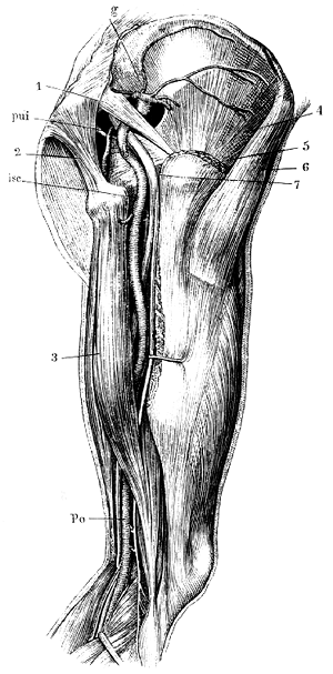 Image of persistent ischiadic artery 