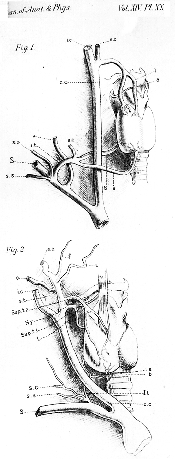 Image of variation of inferior superior thyroid arteries