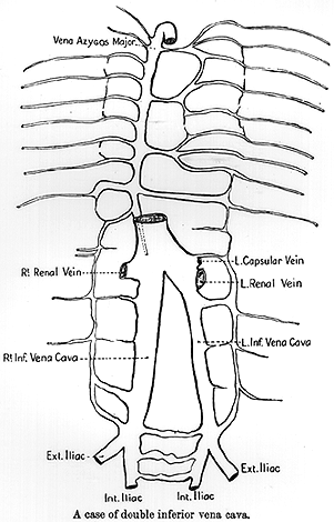 Image of double inferior vena cava