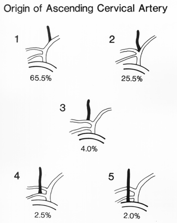 Image of the origin of ascending cervical artery