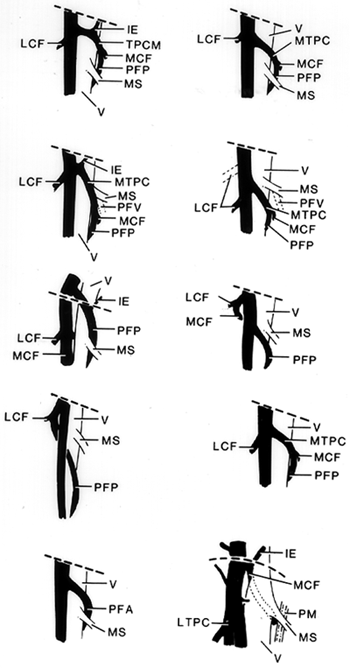 Image of femoral artery and branches