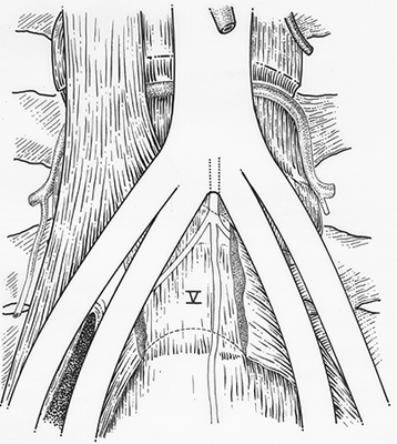 Image of common iliac artery absent, common iliac artery short