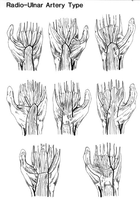 Image of superficial palmar arch, radio-ulnar types