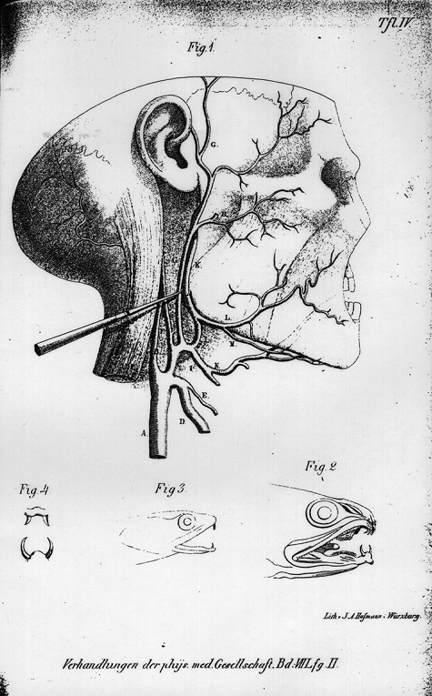 Image of maxillary artery variation