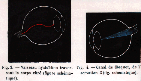 Image of persisten hyaloid artery