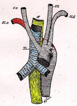 Image of retroesophageal right subclavian artery