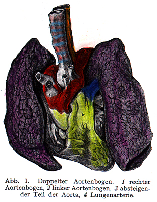 Image of double aortic arch