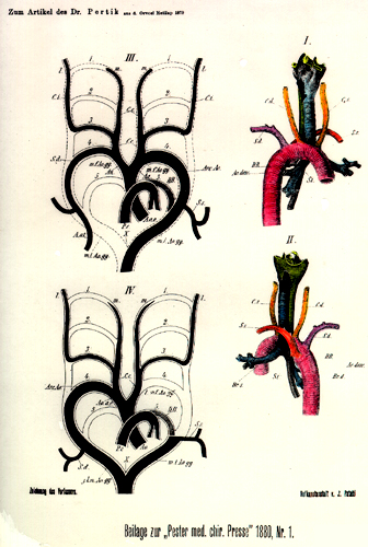 Image of retroesophageal right subclavian artery