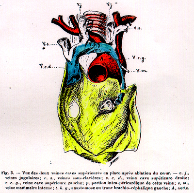 Image of doubled left superior cava