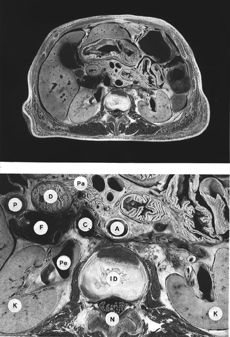 Image of retroaortic left renal vein