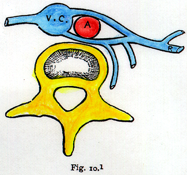 Image of doubled left renal vein