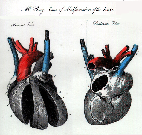 Image of persistent left superior vena cava