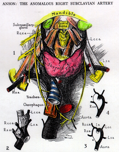 Image of varian right subclavian artery