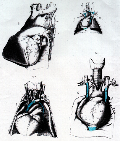 Image of left persistent superior vena cava