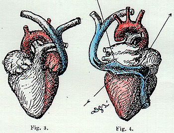 Image of left superior vena cava