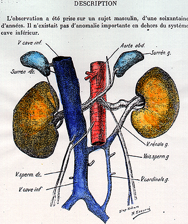 Image of persistent left cardinal vein