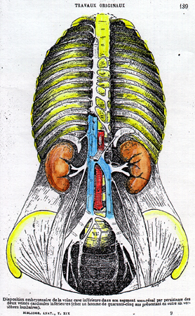 Image of persistent left inferior vena cava