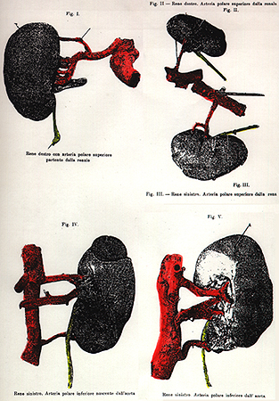 Image of polar renal arteries