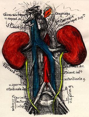 Image of duplicity of inferior vena cava