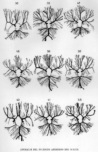 Image of variations of the arterial polygon of Willis