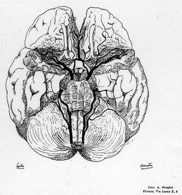 Image of the absence of the basilar artery