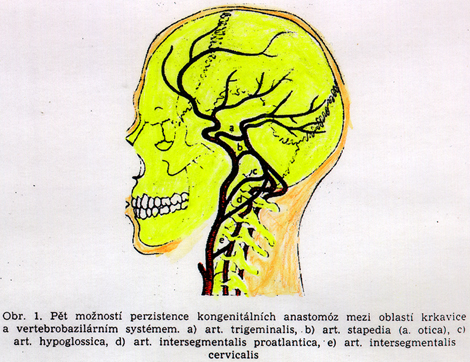 Image of persistent congenital arterial anastomoses