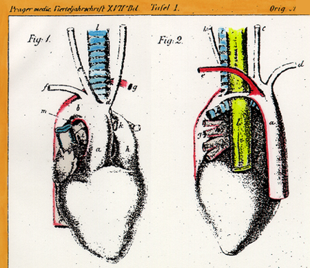 Image of retroesophageal left subclavian artery