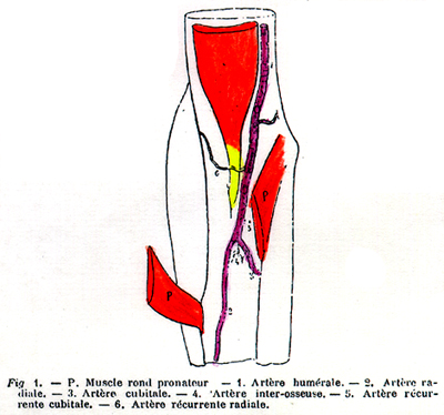 Image of late division of the brachial artery