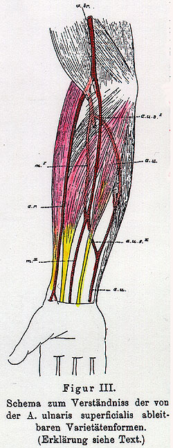 Image of arterial variations in teh human arm, forearm and hand