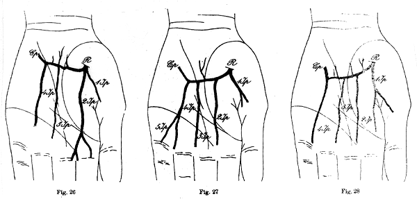 Image of some variations in deep palmar arch