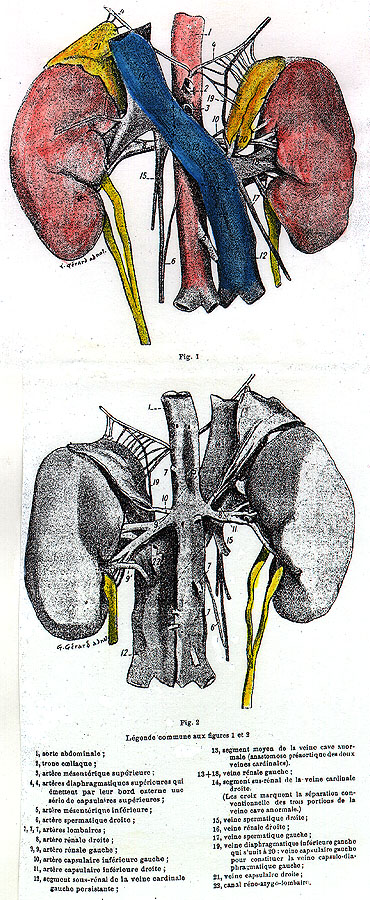 Image of sub-renal persistence of the left cardinal vein