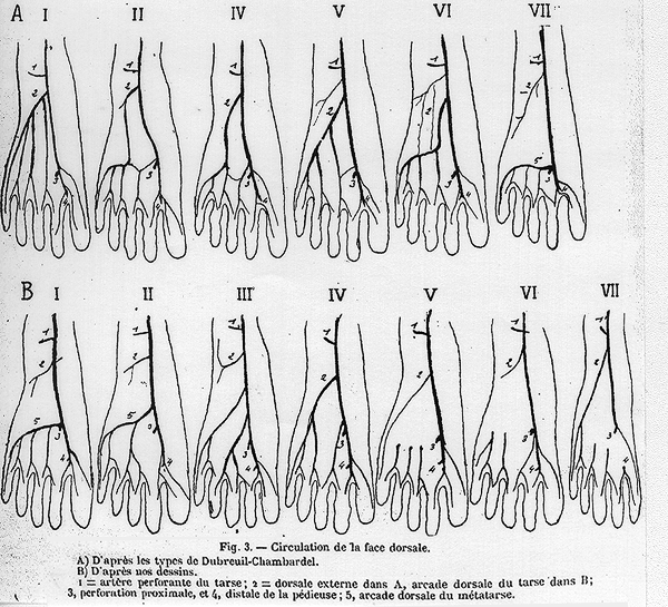 Image of variations in course of dorsalis pedis artery