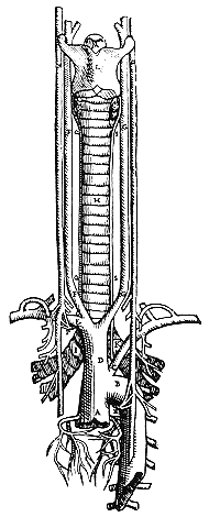 Image of common trunk for the two internal cartids and right subclavian artery