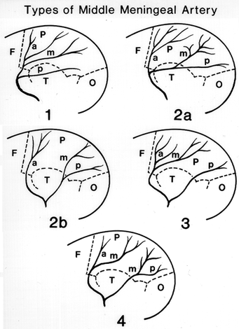 Image of types of middle meningeal artery