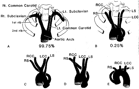 Image of subclavian artery