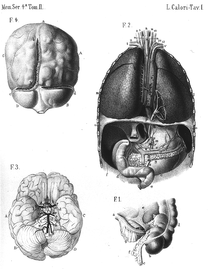 Image of bronchial artery derived from celiac trunk