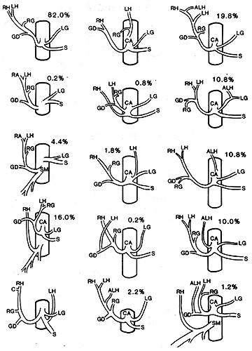 Image of variations in origin of left hepatic artery