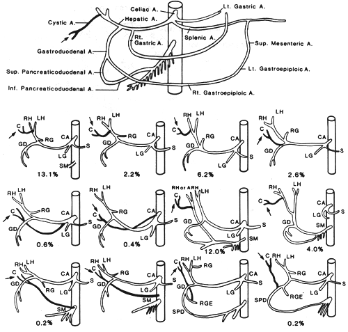 Image of variations in origin of cystic artery