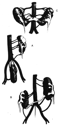 Image of renal arterial variations